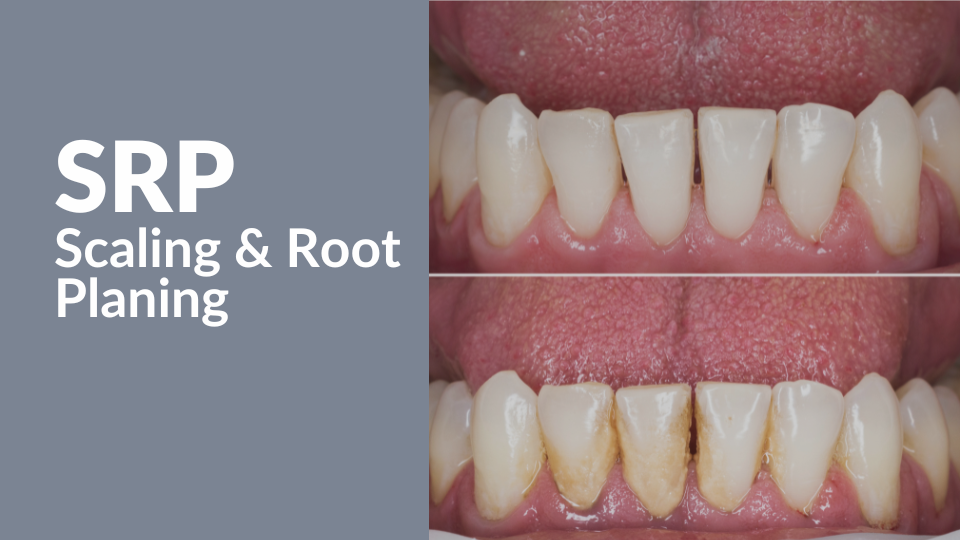 SRP Scaling and Root Planing Successful Billing for Soft Tissue Management